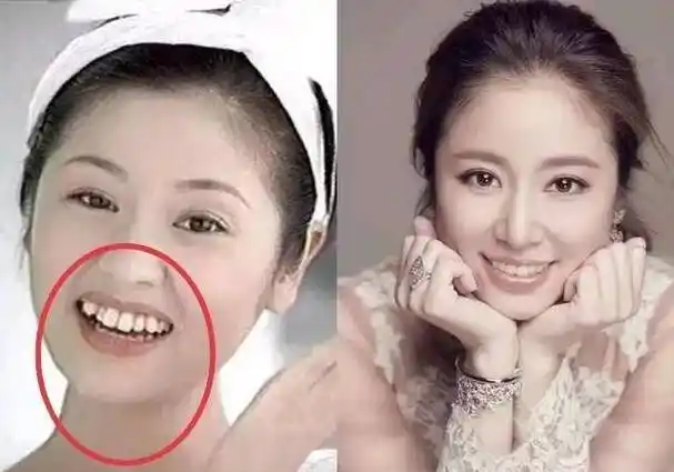 林心如不得不听从经纪公司的意见进行牙齿矫正