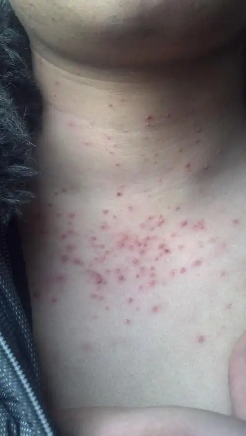 半月前脖子下一点起了点小痘痘,现在变得厉害了,已经蔓延到脖子了