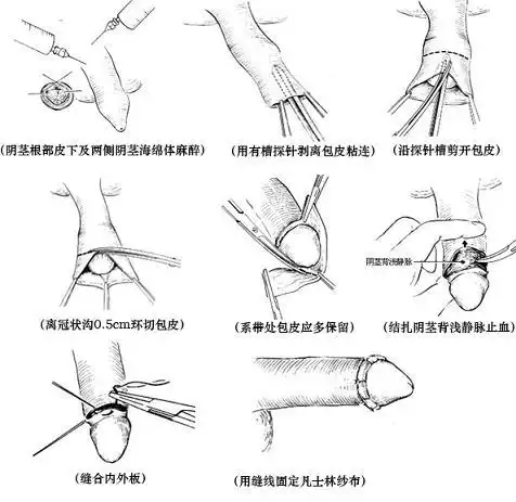 如何正确区分真假包茎?