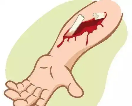 中医开放性骨折后伤口迟迟不好