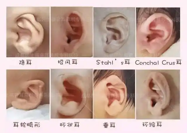婴儿耳廓畸形是什么原因 成都民生无创矫正 爱心无限