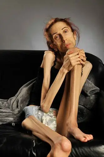 california woman describes long battle with anorexia