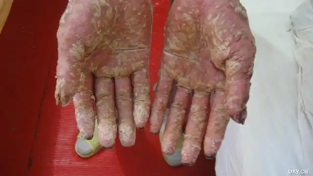 全身皮疹10年,咳嗽并关节痛1周,患者既往有hiv感染史数年.