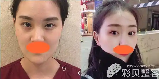 想做双眼皮全切和埋线哪个漂亮真实案例效果对比说明