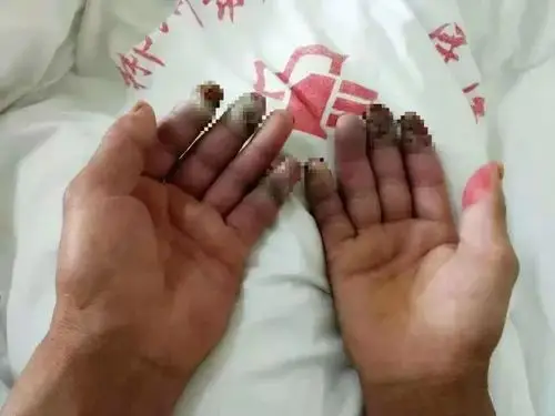 男子手指发黑险截肢竟然与这个许多人都有的嗜好有关