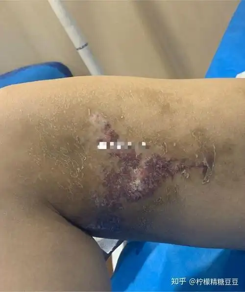 全国吸脂专家测评!吸脂的风险和后遗症有哪些?