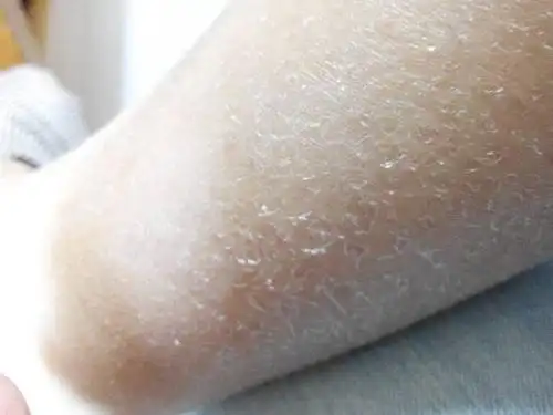 小腿干燥起皮掉屑