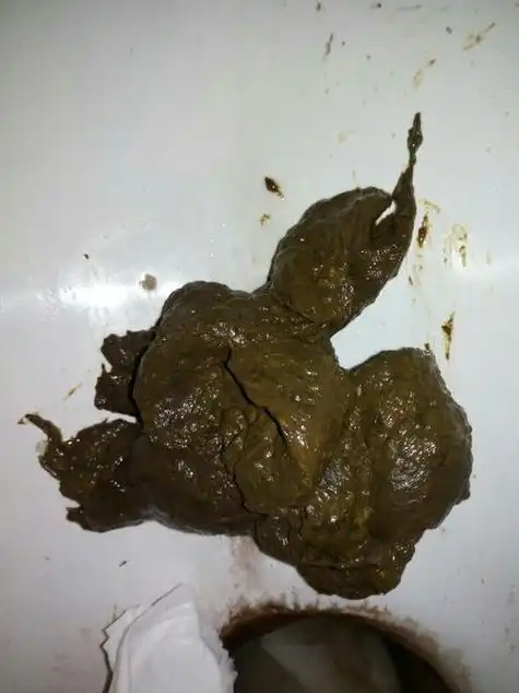 大便颜色深褐色的图片 吃了车厘子大便会不会变成红色的