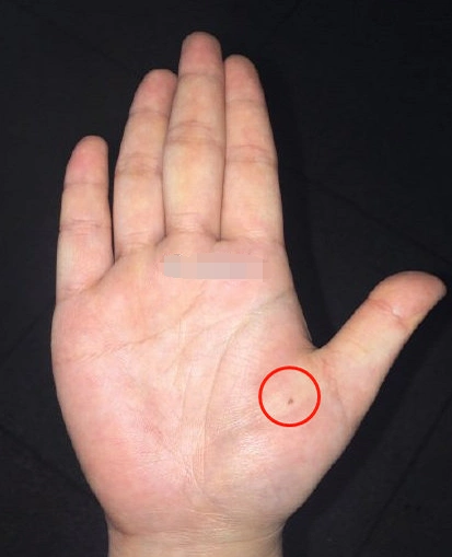 感情线呈现锁链状加上金星丘有痣,审美感非常好,也比较有艺术性,多数