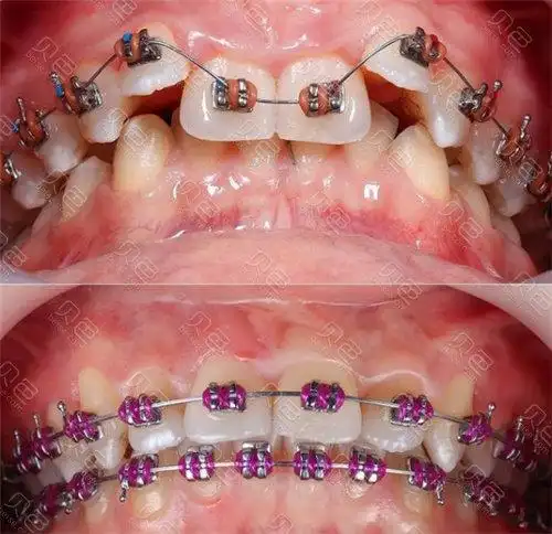 另外学生矫正牙齿能用医保报销吗?