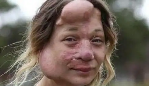 导致了面部发生了巨大的变化,小时候跟许多长相不太正常的小朋友一样