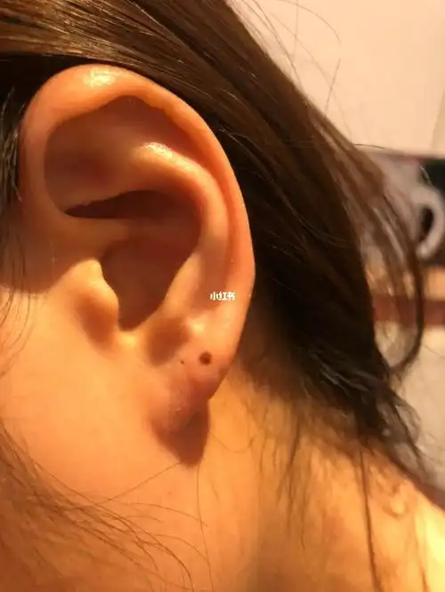 左耳突然长了颗痣06