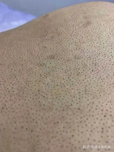 我看到大多数是鼻子上面有黑头我的是脸颊两边有黑头怎么去掉