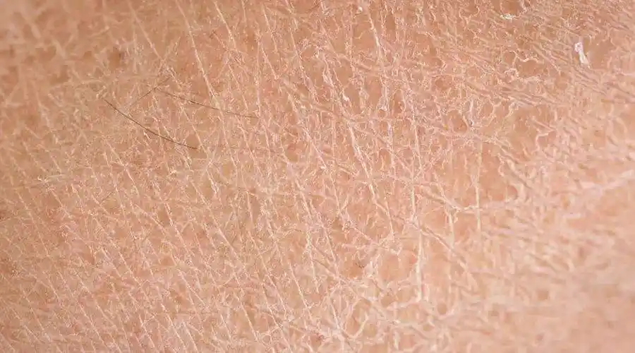 皮肤干燥一定是缺水吗?缺水和缺油有什么区别?