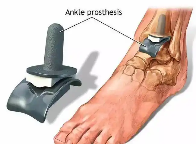 巴蒂在2005年就因为脚踝伤势严重而退役,这份伤病甚至影响了他退役后