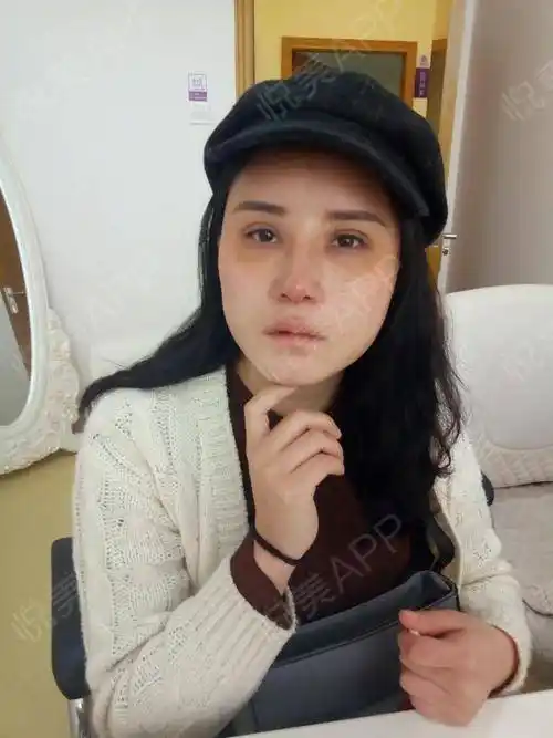 自体脂肪面部填充术后7天_硅胶假体隆鼻术后7天_面部填充术后7天_鼻
