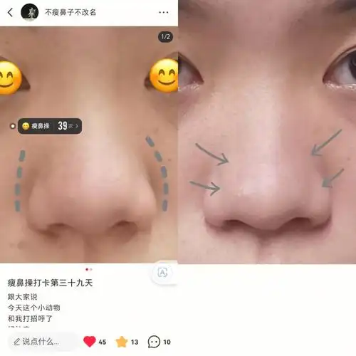 今天认真对比了一下发现这个鼻子真的收进去了不少虽然没有起到瘦鼻翼