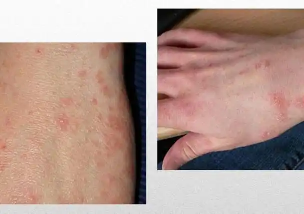 疥疮长什么样子疥疮初期的小红点图片疥疮早期症状图