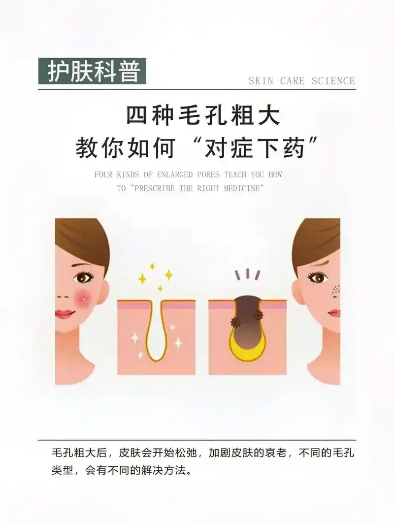 毛孔粗大问题71有这篇就能自救6015.