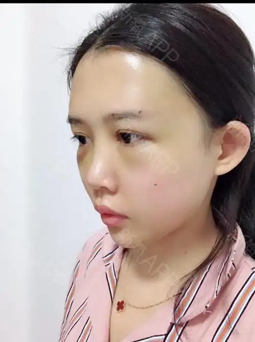 自体脂肪面部填充