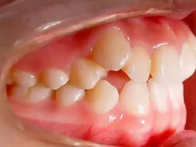 医生通常都不会拔除虎牙,而是选择拔除其他牙齿的原因