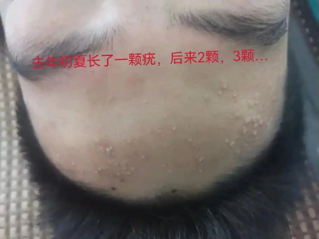 传递健康与美丽 祛疣前后对比图,相信你们也喜欢祛疣后的图片 - 兑趑