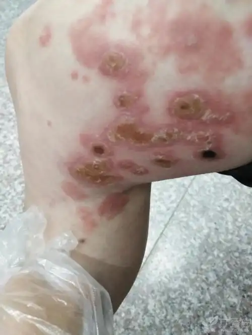 皮肤与性传播疾病讨论版