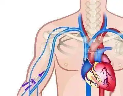 中心静脉血管通路装置安全管理专家共识(2019版)