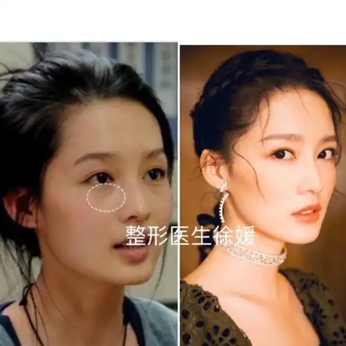 之前看李沁的电视剧就发现她面部清瘦,泪沟严重,苹果_圈子-新氧美容