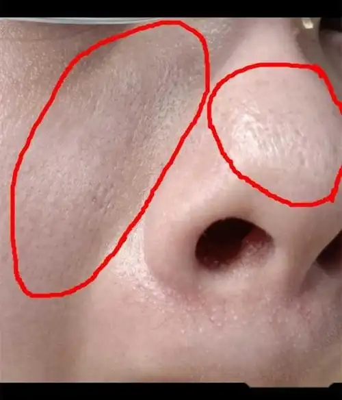 面部皮肤屏障受损怎么办该如何修复受损肌肤