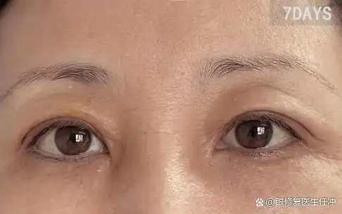 上眼皮松弛下垂怎么办?