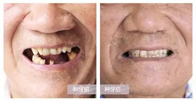 深圳老年人做种植牙多少钱?