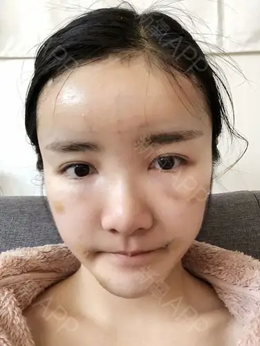 自体脂肪全脸填充好不好_效果图_咖啡爱自体脂肪全脸填充术后第0天