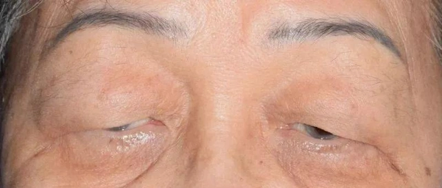 重症肌无力的早期症状重症肌无力饮食方法