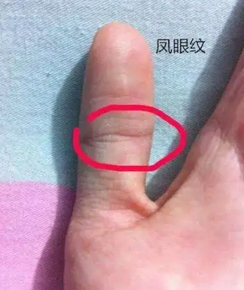 1,凤眼纹,在拇指第一指节有一个完全封闭的圆圈,如果说这个圆圈有开口