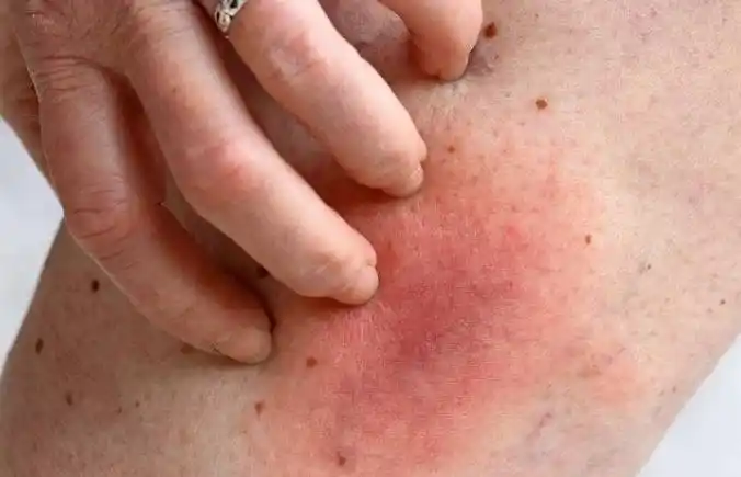 3,莫名的皮肤瘙痒如果近期频频感觉皮肤瘙痒,越抓越痒,但就是没有典型