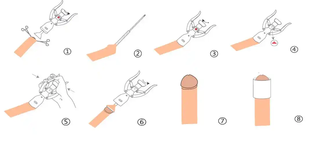 一次性使用包皮切割吻合器-使用说明