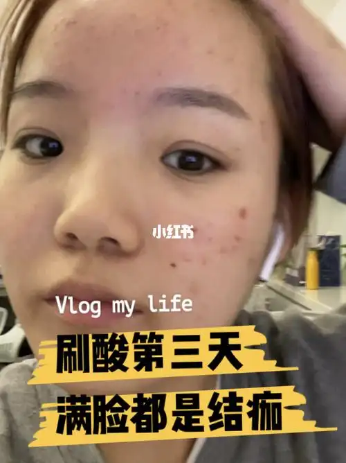 医美果酸换肤,刷酸第三天满脸都是结痂!