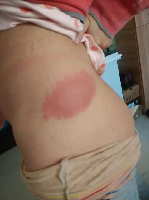 月子里起了这个东西,屁股上一面一个,四五天了,面积越来越大,痒