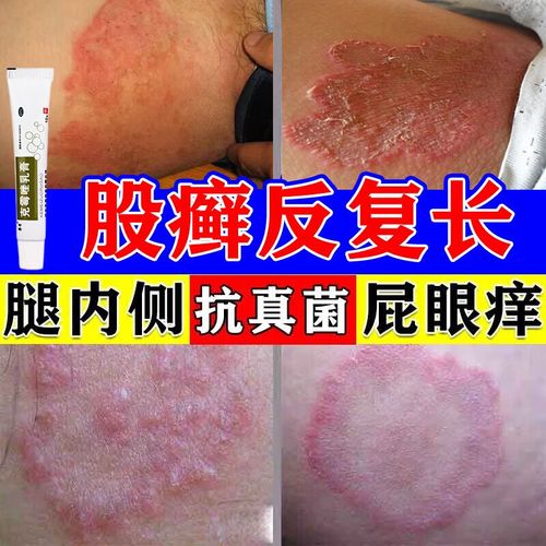 股癣专用药膏】治股藓药膏大腿内侧两侧长癣瘙痒发红潮湿闷热出汗红疹