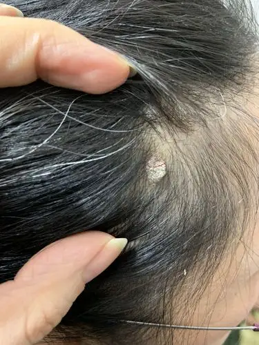 头上长了个包,这是什么?