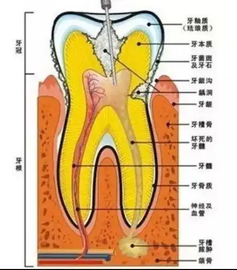 动画视频了解根管治疗步骤
