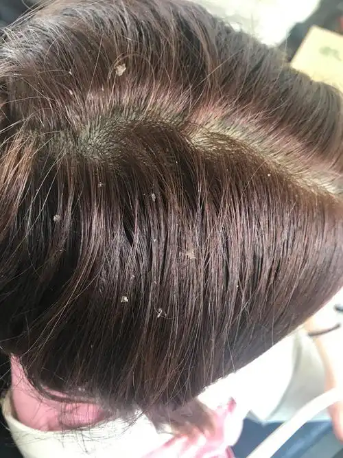 四月份我去染个头发回来,当时染的时候我就说 头发有点蛰的慌!