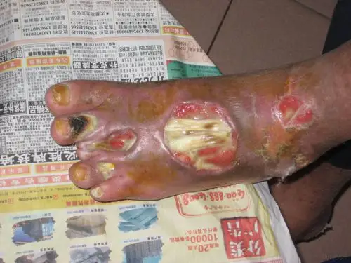 烫伤后皮肤坏死