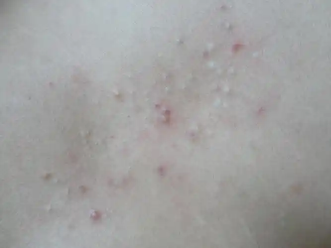 大家来看看胸口上长得疙瘩是什么 - 皮肤及性传播疾病讨论版 - 爱爱医