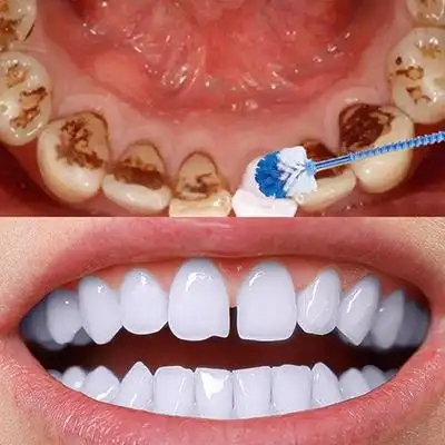 牙齿美白对比照片