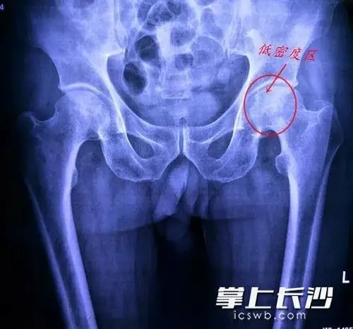 宁乡一60岁男子股骨头坏死,致病原因竟与他40年来的习惯相关