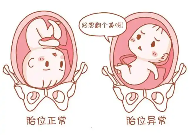 胎位异常.jpg