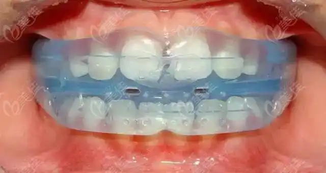 国外禁用儿童mrc矫正器难道是因孩子佩戴myobrace嘴巴闭不上