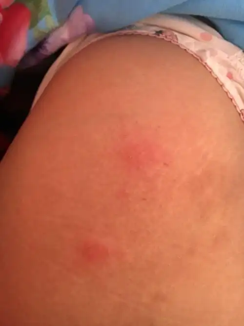 身上起成对的红色疙瘩,特别痒,怎么回事,吃什么药好,着急